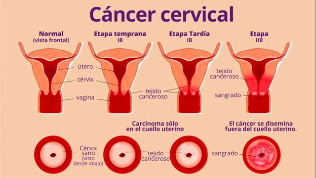 bd-complicaciones-provocadas-por-virus-del-papiloma-humano-230621