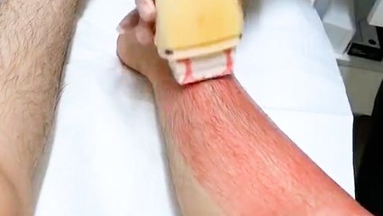 Roll-on wax painlessly removes body hair
