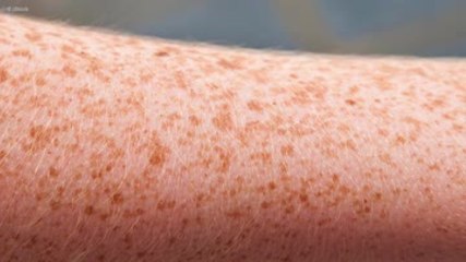 Wie entstehen eigentlich Sommersprossen