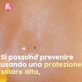 Macchie solari: cause e rimedi