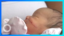 Bayi Dapat 13 Jahitan Pada Pipinya Setelah Jalani Operasi Caesar Darurat - TomoNews