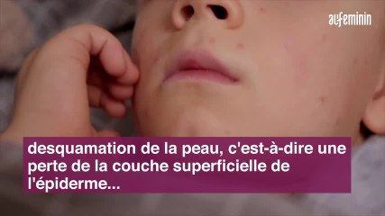 Maladie de Kawasaki : symptômes et traitement