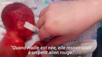 Peau bébé prématuré fine = on voit son cerveau