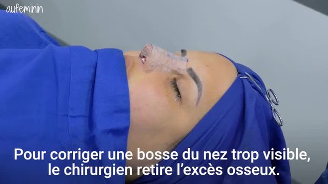 La rhinoplastie : tout savoir sur la chirurgie du nez