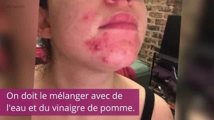 Ce masque est le remède ultime contre l'acné. La preuve en 7 photos !