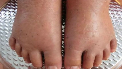 Weight कम ज्यादा होना है एक गंभीर बीमारी का खतरा,जानें Water Retention के लक्षण और घरेलु उपचार