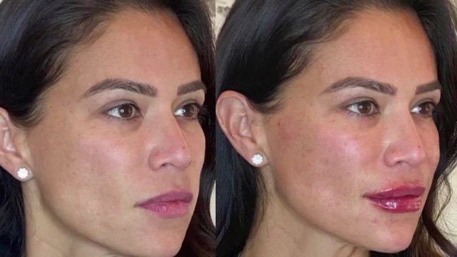 Plump up your lips with the HUSH Pout from HUSH MedSpa