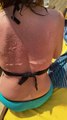 Severe Sunburn Leaves Back Blistered