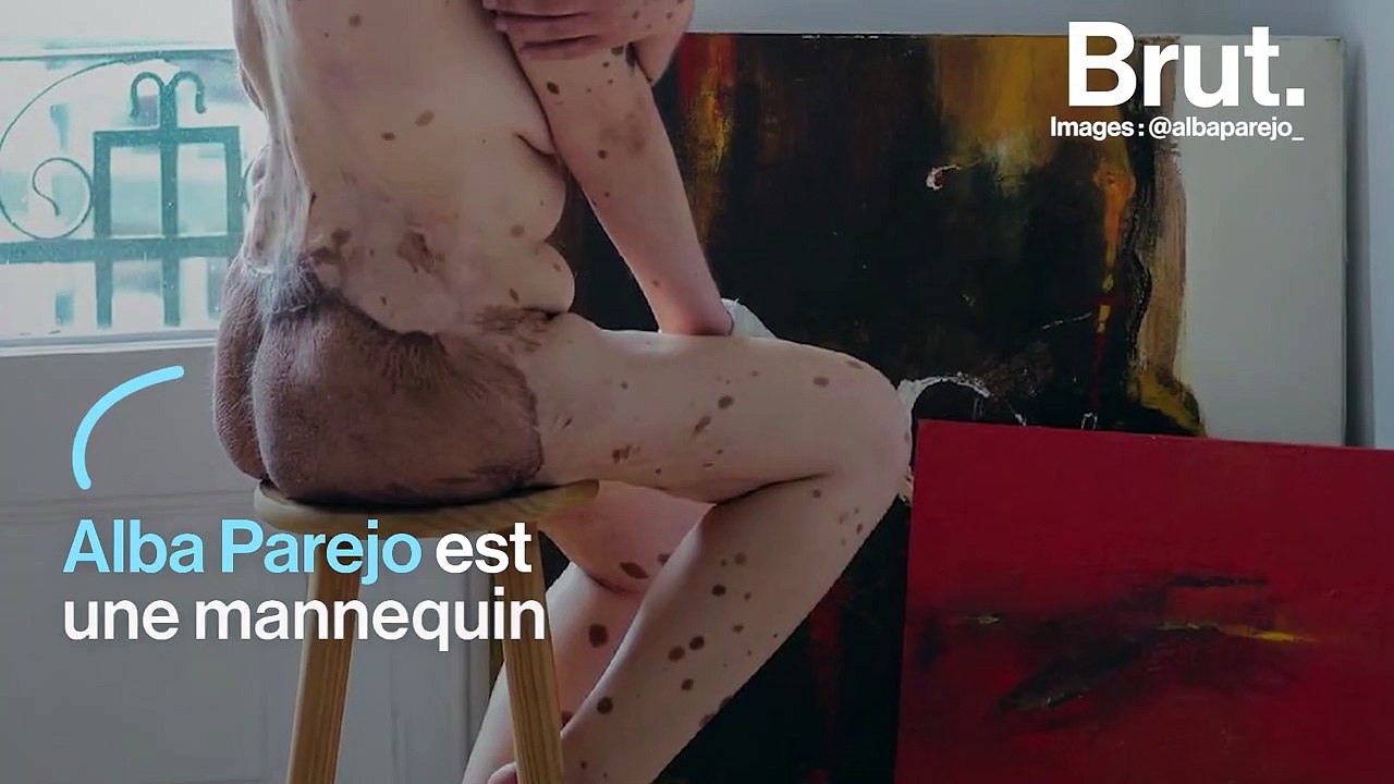Atteinte d'une rare maladie de peau, cette mannequin a appris à s'aimer