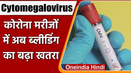 Covid-19 Update: Corona मरीजों में अब CMV इन्‍फेक्‍शन का खतरा, जानें लक्षण । वनइंडिया हिंदी
