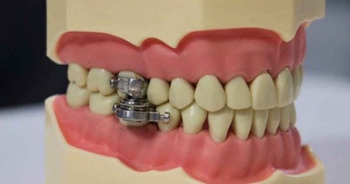 Des chercheurs ont mis au point un dispositif d'amaigrissement qui semble tout droit sorti du film d'horreur Saw