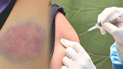 Corona Vaccine Injection लगाने के 1 गलत तरीके से Blood Clotting, Study का दावा | Boldsky