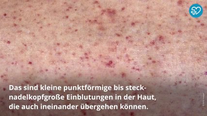 Meningokokken-Meningitis bei Kindern – Glastest