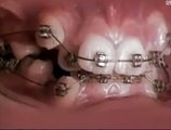 Diş teli nasıl çalışır?