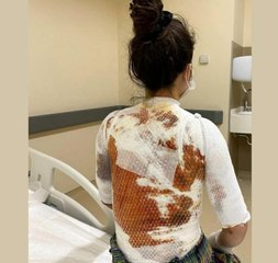Eşinin kaynar suyla yaktığı Rukiye A: "Ölmek istemiyorum"