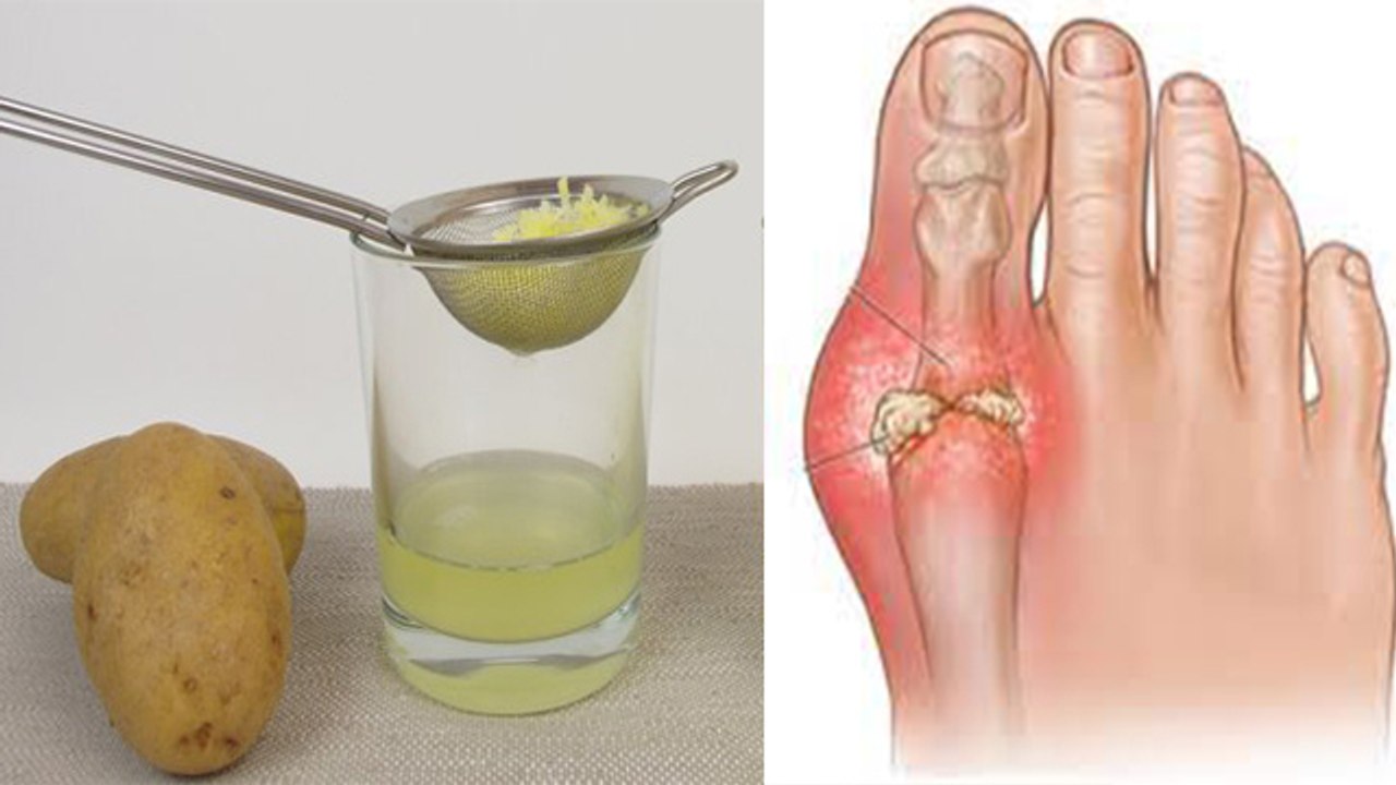 Uric Acid Control करेगा Potato का नुस्खा, जड़ से खत्म होगी बीमारी