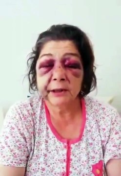 Giresun Eynesil'de Ülfet Dikici isimli vatandaş, belediye başkanının yanındaki adamlar tarafından darp edildiğini söyledi