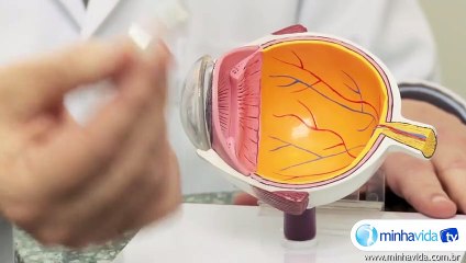 O que é a catarata? - Dúvidas sobre visão