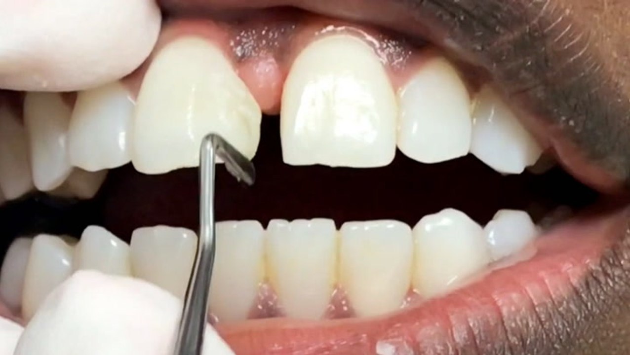 How dentists and fill in tooth gaps