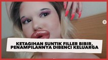 Curhat Mahasiswi Ketagihan Suntik Filler Bibir, Rela Penampilannya Dibenci Keluarga