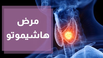 مرض هاشيموتو  أهم المعلومات والتفاصيل