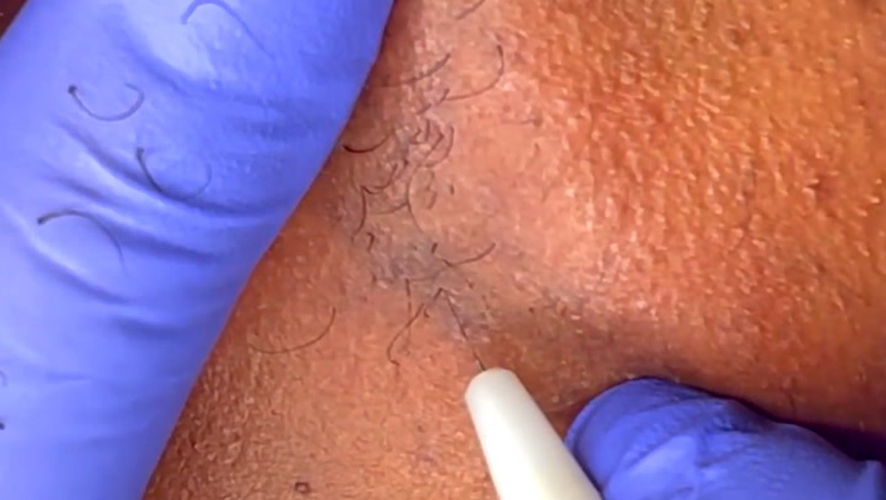 How electrolysis permanently removes body hair