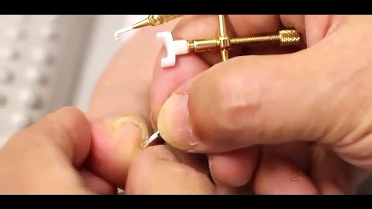 Batık tırnak nasıl düzeltilir?