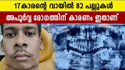 വായിൽ 82 പല്ലുകളുമായി യുവാവ്. മുഖത്തിന്റെ അകൃതി നഷ്ടപ്പെട്ടു | Oneindia Malayalam