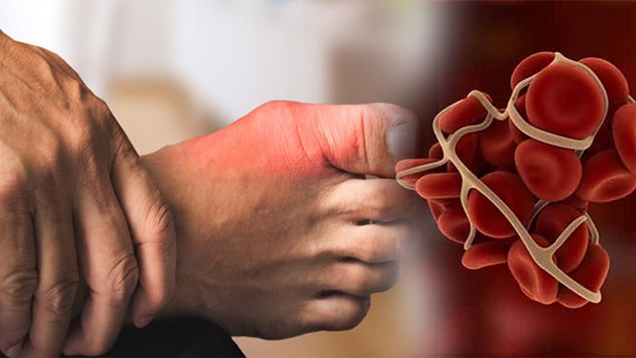 गठिया के लक्षण और दूर करने का उपाय | Arthritis symptoms | Boldsky