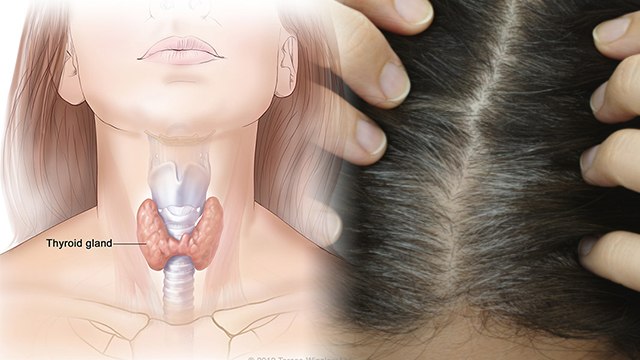 कम उम्र में बाल सफेद होने का कारण | Kam Umra Me Bal Safed Hone Ka Karan | Boldsky