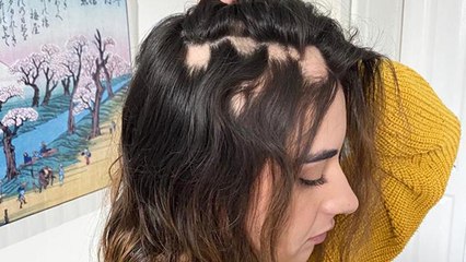 Post Covid 1 गलती से Baldness का शिकार, Symptoms ना करें नजरअंदाज | Boldsky