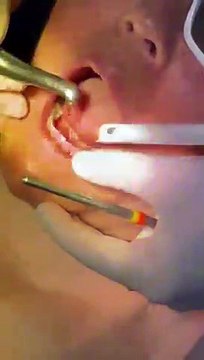 Laser Teeth Whitening | Phoenix AZ