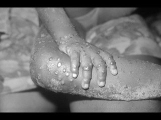 Texas Monkeypox case reported in traveler to Nigeria