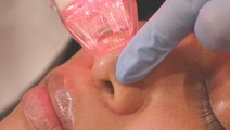 How a radio-frequency microneedling machine reduces hyperpigmentation