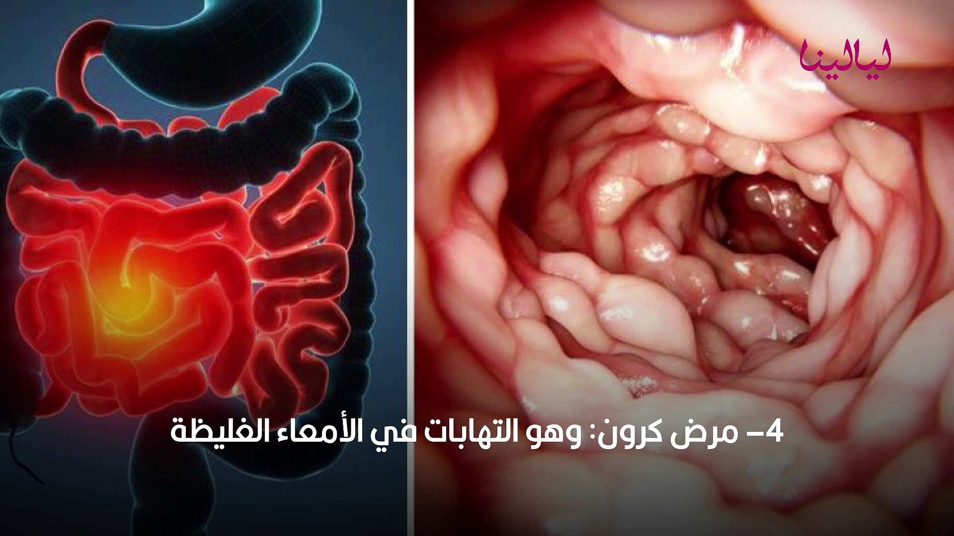 مخاط احمر في براز الرضيع