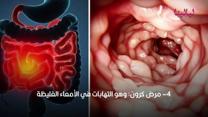 الدم في براز الطفل الرضيع.. أسبابه وعلاجه