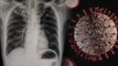 Coronavirus से खराब हुए Lungs इतने Months बाद अपने आप हो रहे हैं Recover | Boldsky