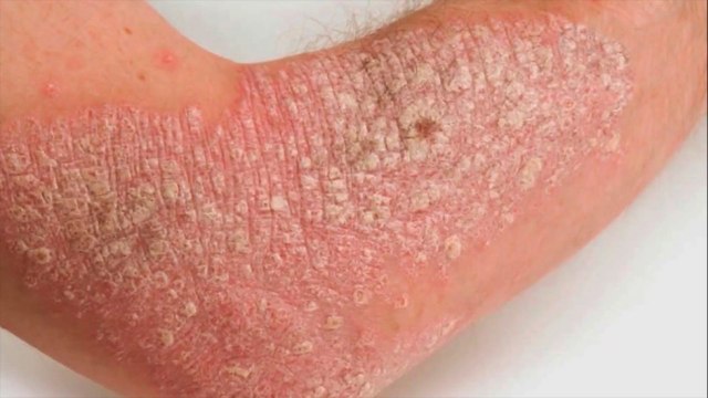 bd-hablamos-de-los-tratamientos-para-la-psoriasis-190721