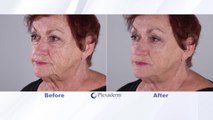 Get rid of under eye bags and wrinkles for up to 10 hours with Plexaderm
