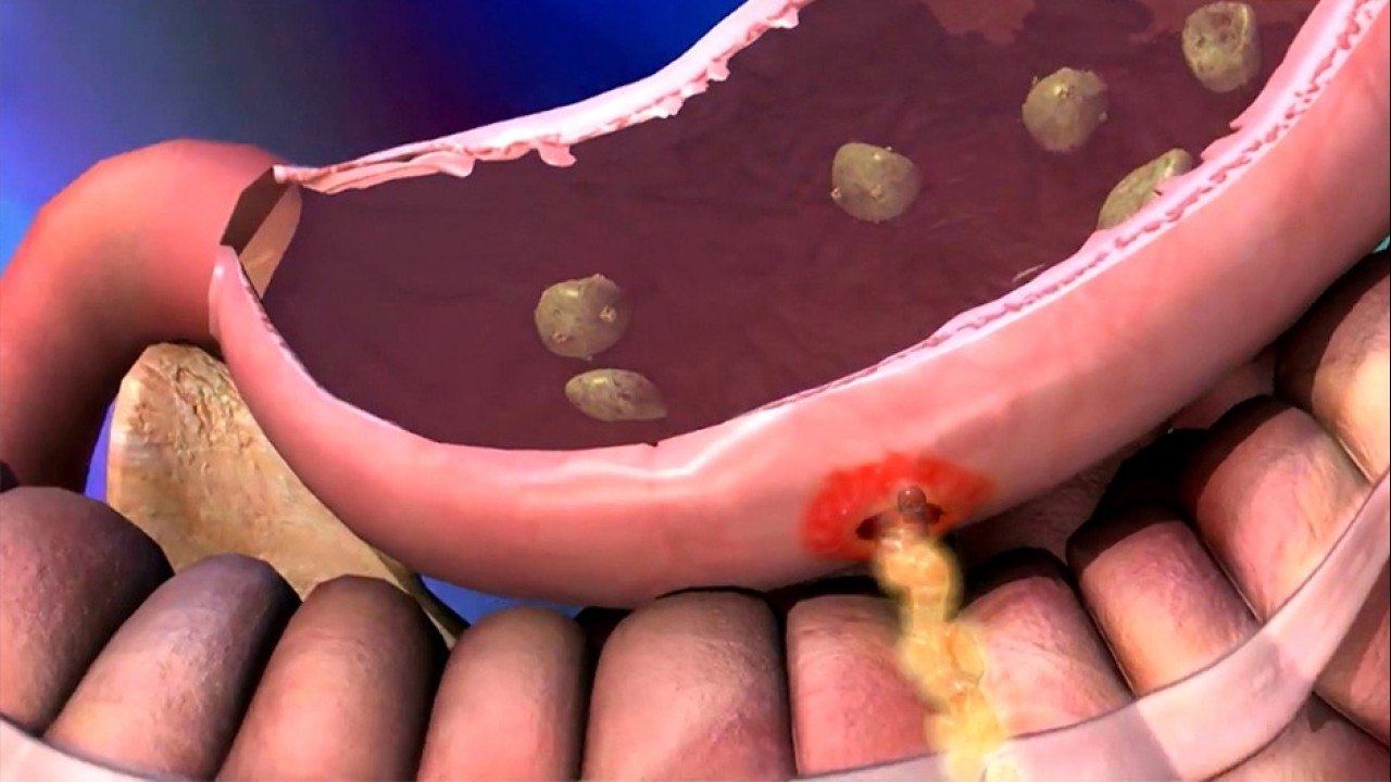 bd-gastritis-ulceras-gastricas-causas-sintomas-y-tratamientos-220721