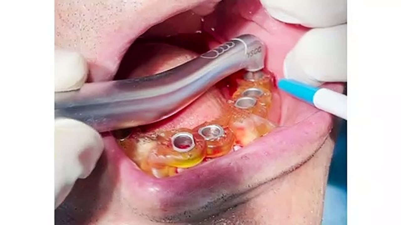 Navigasyonlu lazer destekli implant uygulaması