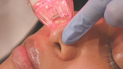 How a radio-frequency microneedling machine reduces hyperpigmentation