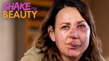 After Years Of Hiding - I'm Ready To Embrace My Birthmark | SHAKE MY BEAUTY