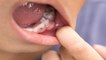 दांतों में लगा है कीड़ा तो तुरंत करें ये 1 घरेलू उपाय | Home Remedies for Teeth Cavity | Boldsky