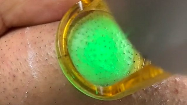 Laser treatment zaps out ingrown hairs to prevent hair regrowth