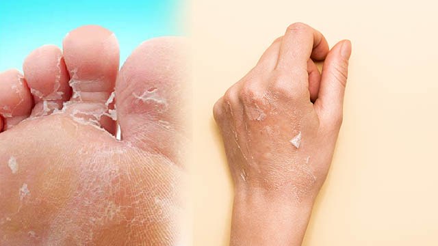 Monsoon में हाथों-पैरों की उतर रही है Skin तो तुरंत करें ये काम | Boldsky