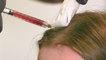 PRF hair treatment can promote natural hair growth for balding hair