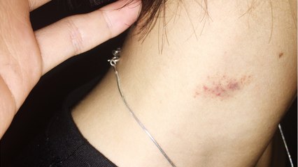 Six Ways To Get Rid of a Hickey That Actually Work