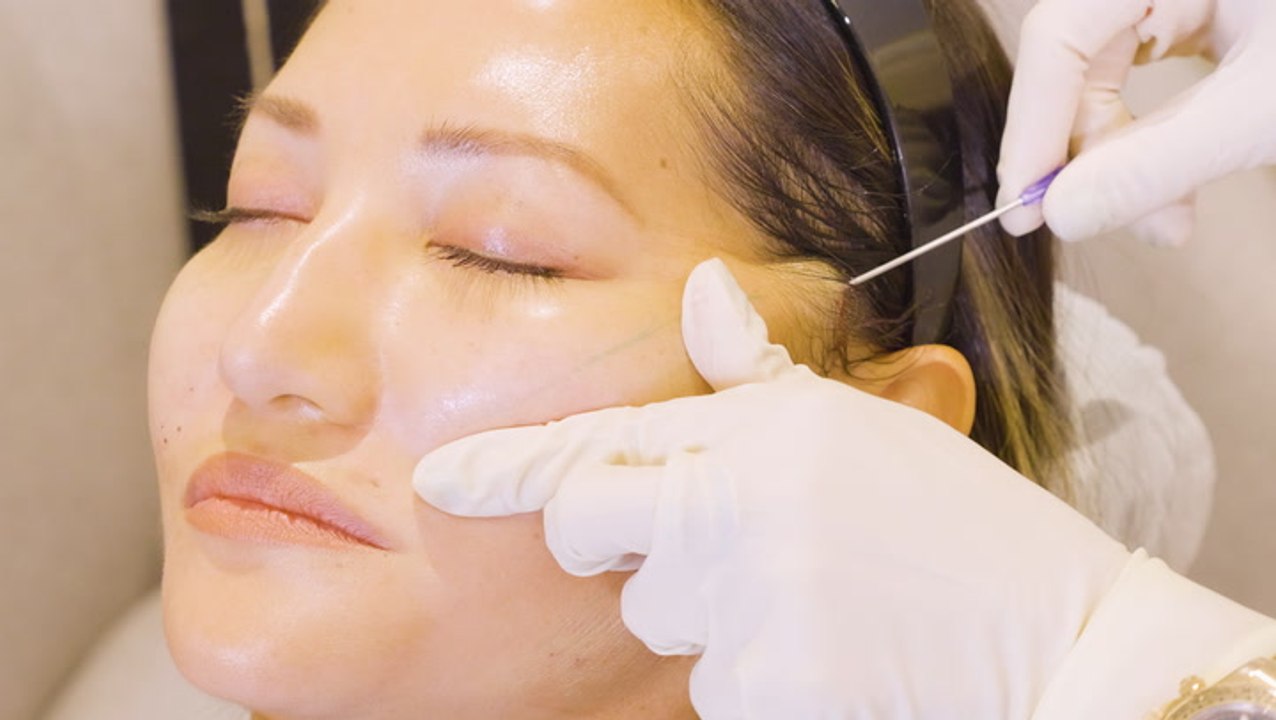 How nonsurgical face lifts work with PDO threads