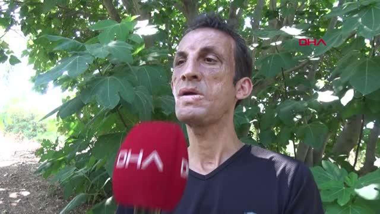 TÜRKİYE'NİN İLK YÜZ NAKİLLİSİ UĞUR ACAR; ÖNCE YÜZÜM ŞİMDİ DE ANILARIM YANDI